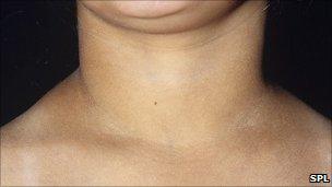 picture of a neck with hypothyroidism