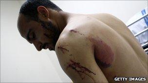 Injured demonstrator, Manama (17 Feb 2011)