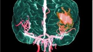 Cholesterol 'does not predict stroke in women' - BBC News