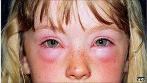 Child having allergic reaction