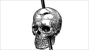 Drawing of Phineas Gage showing path of iron rod through his brain