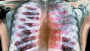 Lungs of patient with TB