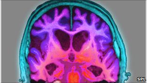 MRI Brain scan