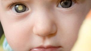 Иллюстрация того, как ретинобластома может выглядеть в глазах маленького ребенка