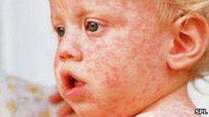 A baby boy with measles
