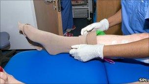 patient is fitted with compression stocking