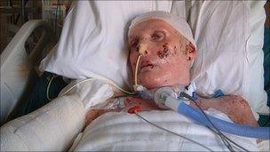 Gordon Metcalf in hospital after the fire