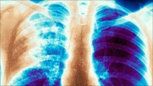 X-ray of the chest of a patient with TB