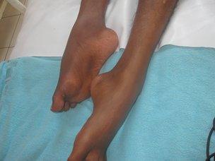 Sukidi's feet, after years of shackling