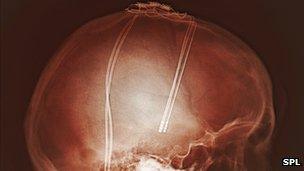 Electrodes in skull