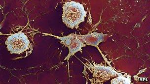 Multiple sclerosis cells