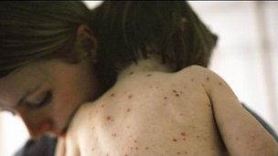 Child with chickenpox