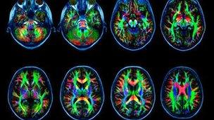Brain scans of white matter