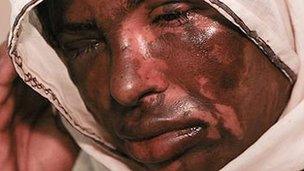 Acid attack victim Masqood