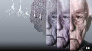 Conceptual computer artwork showing the brain of an elderly man affected by Alzheimer's disease