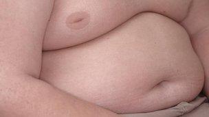 Torso of an obese boy