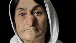 Woman, with facial deformity caused by mustard gas