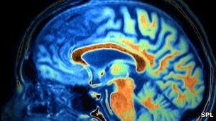 Frontotemporal dementia on MRI scan
