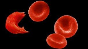 Sickle and normal blood cells