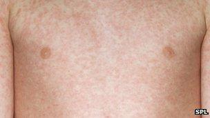 Measles rash on a boy's chest