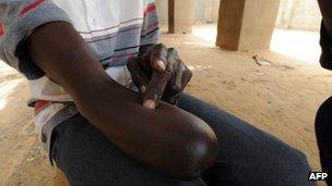 A Malian, who was amputated for alleged theft by Mujao Islamists, shows his missing limb on 31 January 2013 in the northern Malian city of Gao