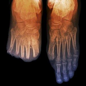 Foot x-ray