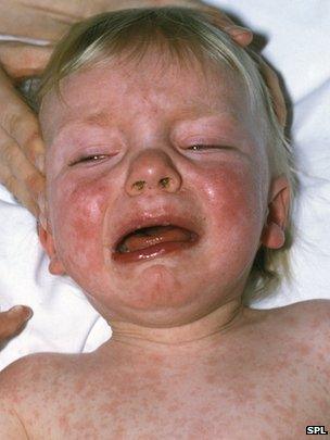 Child with measles