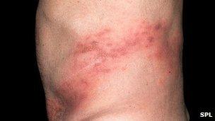 Shingles rash