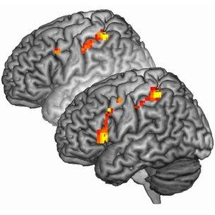 Brain activation in individuals with psychopathy was greater when asked to imagine pain (foreground)