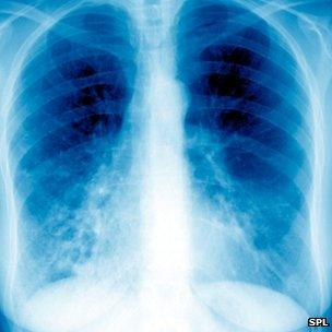 An X-ray of the lungs showing bronchiectasis