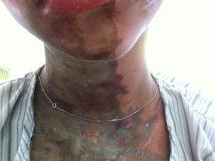 Acid burn marks left on skin of one of the two British teenage victims in Zanzibar