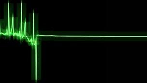 ECG (electrocardiogram) trace