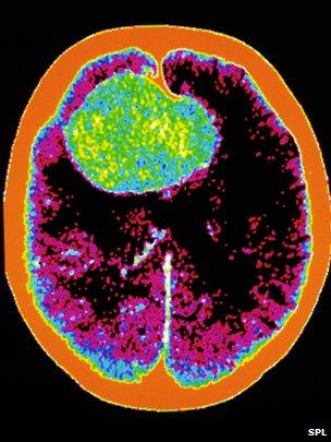 CT scan of a brain haemorrhage or bleeding on the brain