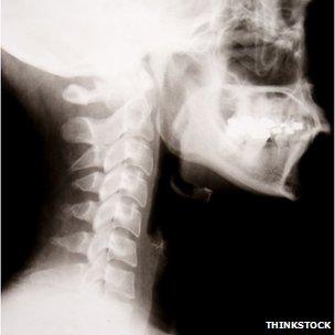 An x-ray of a neck and skull