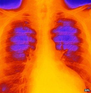 Coloured chest x-ray of patient suffering from cardiomyopathy