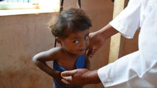 Madagascan child being weighed