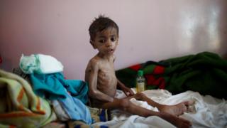 Wani yaro mai fama da tamowa a Yemen