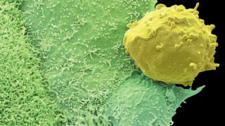Prostate cancer cell