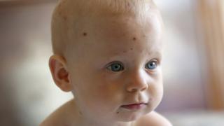 Chickenpox on a 1-year-old child's face