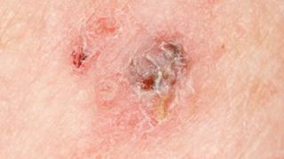 Melanoma