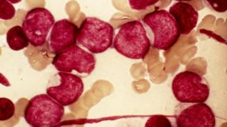 Клетки крови из костного мозга в случае острого миелоидного лейкоза (ОМЛ)