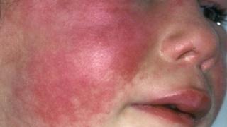 Scarlet Fever