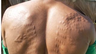 Man in Womburn with back scarred to resemble a crocodile's hide