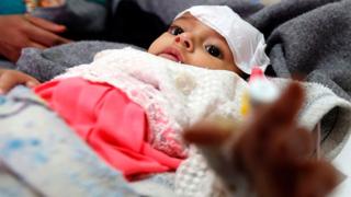 طفل يمني مصاب بالكوليرا