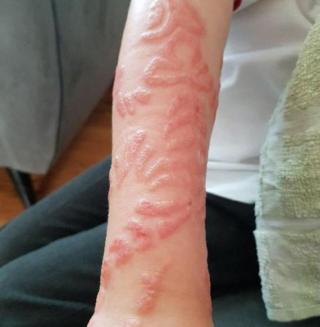  Black henna  tattoos  leave boys with chemical burns  BBC 