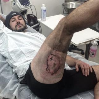 Gareth Clear showing burn on leg
