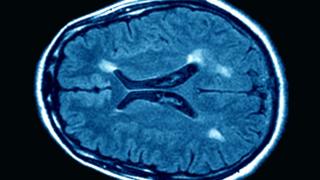 Brain scan