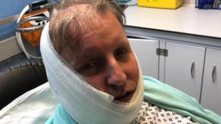 glover johnson mike corrosive hospital bbc face substance bloxwich thrown man injuries recovering caption copyright his mirror