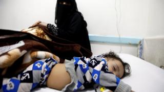 A Yemeni girl infected with cholera lies in a bed at a hospital in Sanaa, Yemen (11 October 2018)