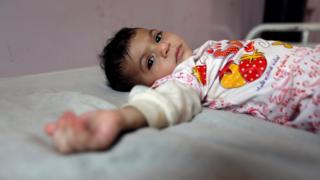 طفلة يمنية مستلقية على سرير في مستشفى - 2017